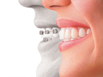 The image shows a split-screen comparison of two individuals with different dental treatments  one with straight teeth and one with braces, emphasizing the difference between their smiles.
