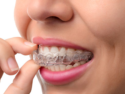The image shows a person wearing clear braces with metal bands, holding their finger near their mouth as if inspecting them.