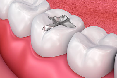 This image features a close-up view of a set of teeth with an engagement ring inserted between them.