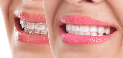 The image shows a close-up of two human faces with smiling expressions, displaying straight white teeth and pink lips.