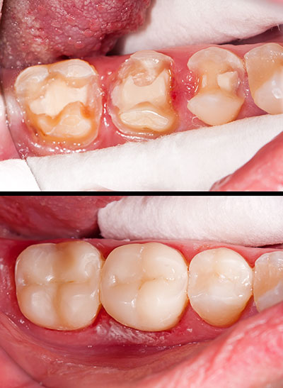 The image shows a close-up view of a mouth with several teeth and gums, featuring various stages of decay and disease, with some teeth appearing rotten and discolored, and others showing signs of inflammation and infection.