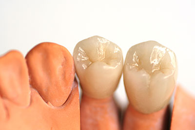 The image shows a close-up of two human teeth with an artificial tooth placed between them.