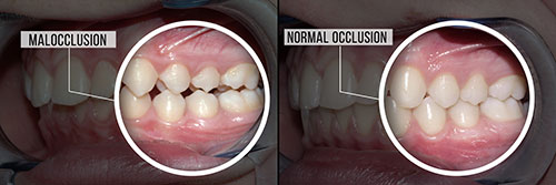 The image shows a sequence of three photos with captions indicating stages of tooth decay progression, highlighting the importance of dental hygiene.