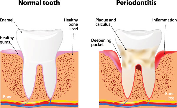 The image presents two stages of tooth decay  normal and gum disease, with a focus on the anatomy of the teeth and their surrounding tissue.