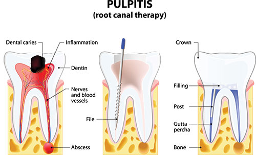 The image displays a medical illustration showing a cross-sectional view of a tooth with its root canal therapy process highlighted, labeled  Pulpit,  indicating areas such as  Dental caries  and  Inflammation,  with annotations pointing to different parts of the tooth structure.