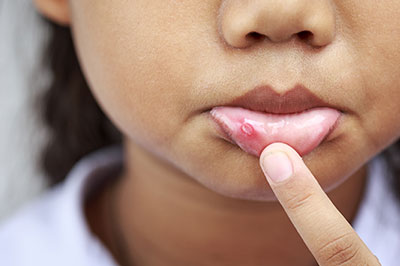 This is a close-up photograph of a young child with a small red bump on their chin, looking directly at the camera with their finger touching the bump.