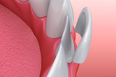 The image displays a close-up view of a dental implant being placed into a jaw, with a focus on the surgical process involving a drill and screw.