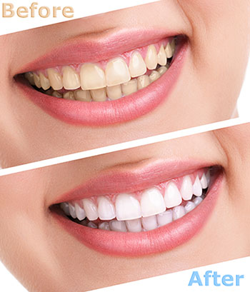 The image shows a side-by-side comparison of a person s teeth before and after a teeth whitening treatment, highlighting the dramatic improvement achieved through the cosmetic dental procedure.