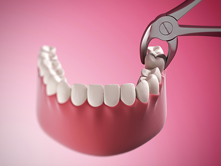 The image shows a pair of pliers with teeth being removed from a mouth model.