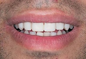 Frisco Smiles Dentistry | Fluoride Treatment, Dental Fillings and Invisalign reg 