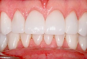 Frisco Smiles Dentistry | Dental Cleanings, Cosmetic Dentistry and Veneers
