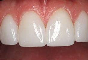Frisco Smiles Dentistry | Oral Exams, Invisalign reg  and Dental Sealants