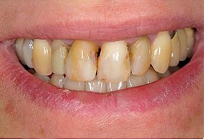 Frisco Smiles Dentistry | Dental Cleanings, Cosmetic Dentistry and Night Guards