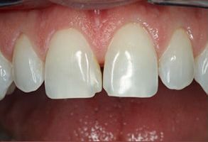 Frisco Smiles Dentistry | Ceramic Crowns, Dental Cleanings and Extractions